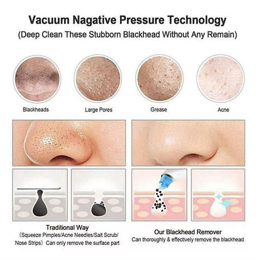 Lilhe Vacuum Suction Pore Cleanser- White